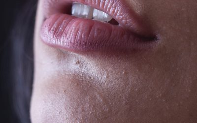 Hoe kom je van droge lippen af?